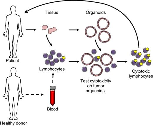 Fig. 2. Exploiting adult stem cell-derived organoids for immunotherapy. In parallel with establishing organoids, immune cells (e.g. lymphocytes) can be isolated from the same patient-derived tissue, expanded and potentially primed in an in vitro co-culture with organoids. Tumor-derived organoids can also be exploited to test immune cell cytotoxicity towards the tumor cells. Cytotoxic immune cells could subsequently be expanded and transplanted back into the patient. Similarly, blood from healthy donors has been shown to provide a source of neo-antigen-recognizing T cells, a specialized type of lymphocyte (Stronen et al., 2016). Co-culturing donor-derived T cells with tumor-derived organoids could be used to predict the cytotoxicity of these T cells towards patient-derived tumor organoids, potentially predicting the in vivo patient response. T cells that demonstrate in vitro cytotoxicity could subsequently be expanded in vitro and administrated to the patient to evoke an anti-tumor immune response. Solid arrows indicate biological material derived from the patient; dashed arrows indicate biological material derived from a healthy donor.